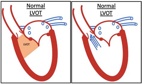 lvot|lvot meaning.